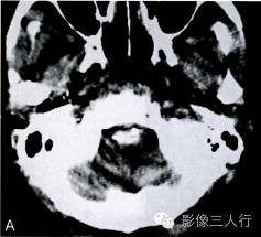 【病例】中枢神经系统肠源性囊肿1例MR影像表现 【病例】中枢神经系统肠源性囊肿1例MR影像表现