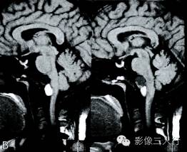 【病例】中枢神经系统肠源性囊肿1例MR影像表现