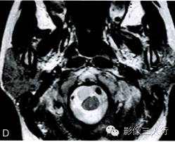 【病例】中枢神经系统肠源性囊肿1例MR影像表现 【病例】中枢神经系统肠源性囊肿1例MR影像表现