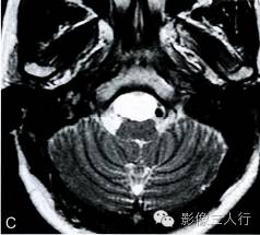 【病例】中枢神经系统肠源性囊肿1例MR影像表现 【病例】中枢神经系统肠源性囊肿1例MR影像表现