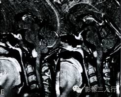 【病例】中枢神经系统肠源性囊肿1例MR影像表现 【病例】中枢神经系统肠源性囊肿1例MR影像表现