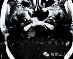 【病例】中枢神经系统肠源性囊肿1例MR影像表现 【病例】中枢神经系统肠源性囊肿1例MR影像表现