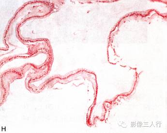 【病例】中枢神经系统肠源性囊肿1例MR影像表现 【病例】中枢神经系统肠源性囊肿1例MR影像表现