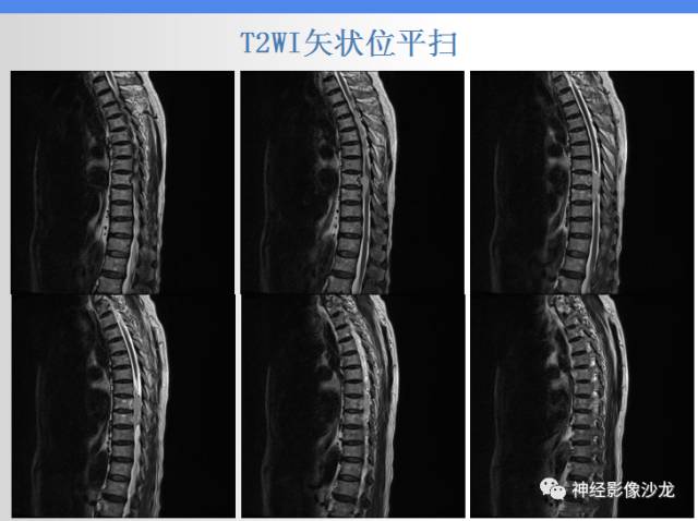 【病例】椎管内海绵状血管瘤1例MR影像表现
