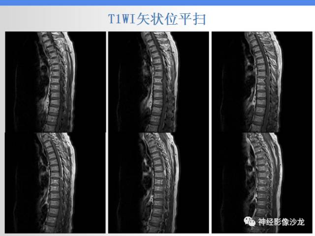 【病例】椎管内海绵状血管瘤1例MR影像表现