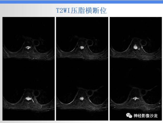 【病例】椎管内海绵状血管瘤1例MR影像表现