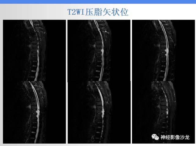 【病例】椎管内海绵状血管瘤1例MR影像表现