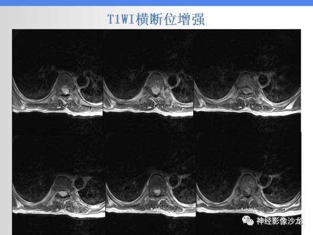 【病例】椎管内海绵状血管瘤1例MR影像表现