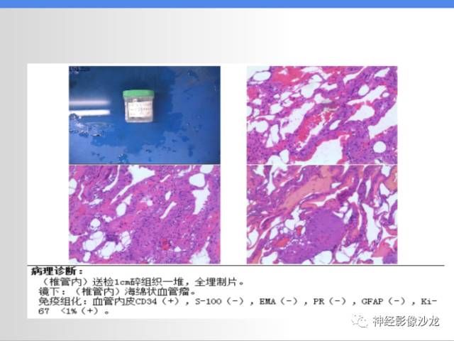 【病例】椎管内海绵状血管瘤1例MR影像表现