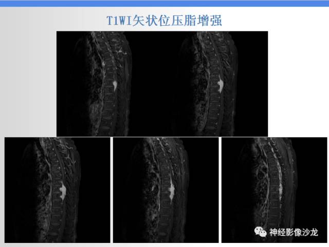 【病例】椎管内海绵状血管瘤1例MR影像表现