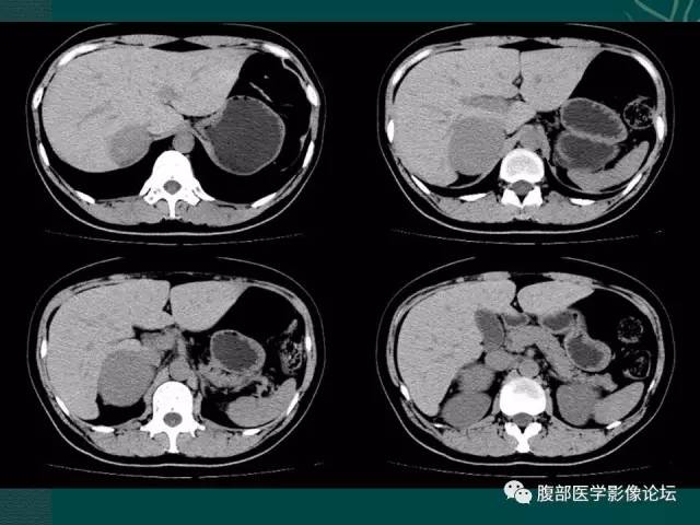【病例】右侧肾上腺嗜铬细胞瘤1例CT