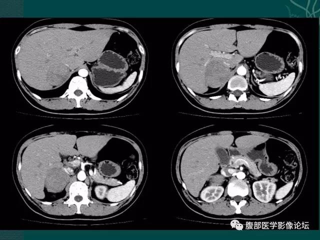 【病例】右侧肾上腺嗜铬细胞瘤1例CT