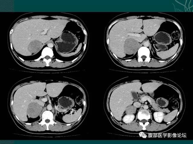 【病例】右侧肾上腺嗜铬细胞瘤1例CT