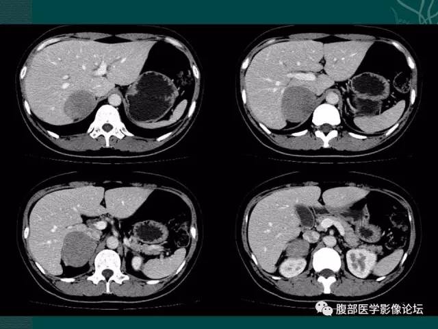 【病例】右侧肾上腺嗜铬细胞瘤1例CT