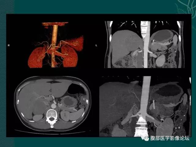 【病例】右侧肾上腺嗜铬细胞瘤1例CT