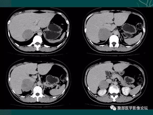 【病例】右侧肾上腺嗜铬细胞瘤1例CT