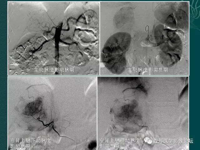 【病例】右侧肾上腺嗜铬细胞瘤1例CT
