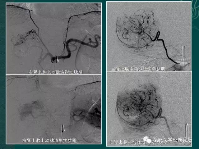 【病例】右侧肾上腺嗜铬细胞瘤1例CT