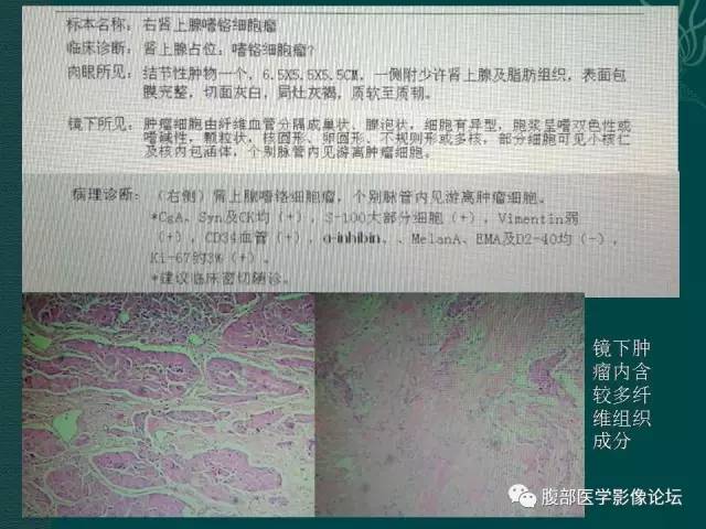 【病例】右侧肾上腺嗜铬细胞瘤1例CT