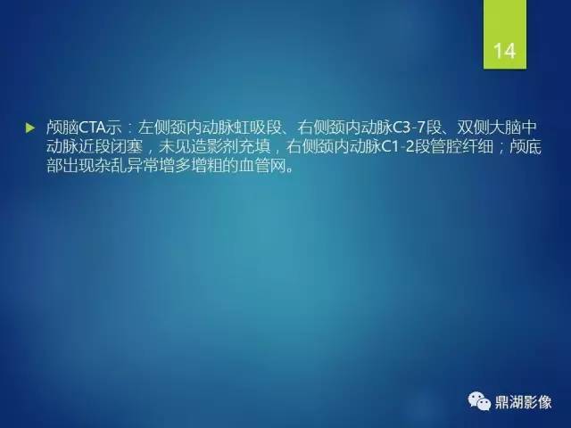 【病例】烟雾病1例CT影像表现