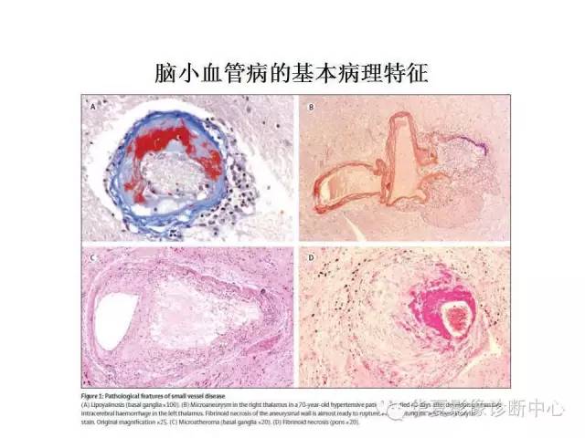 【PPT】脑小血管病