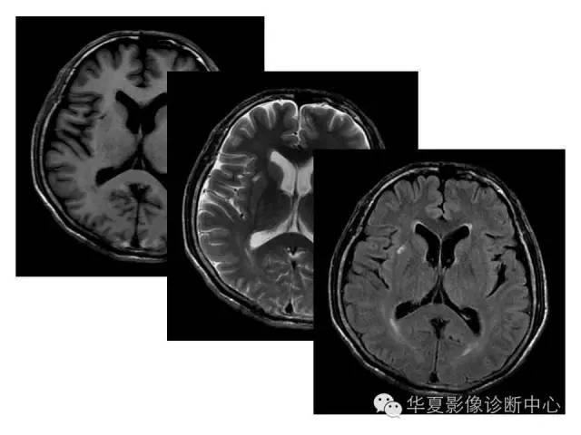 【PPT】脑小血管病