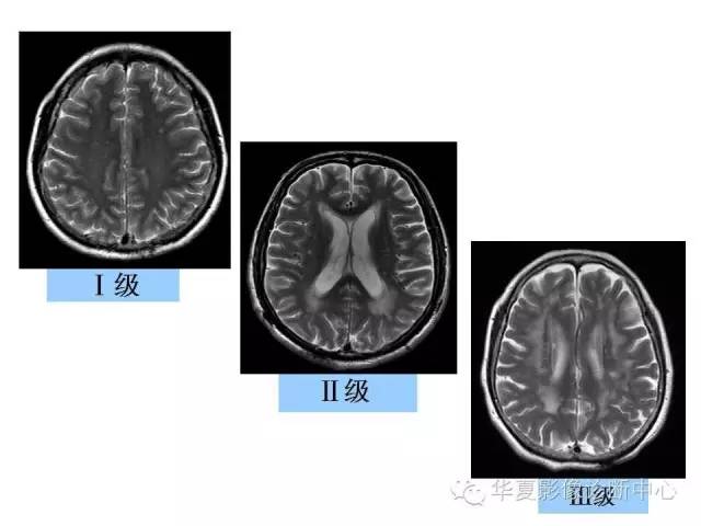 【PPT】脑小血管病