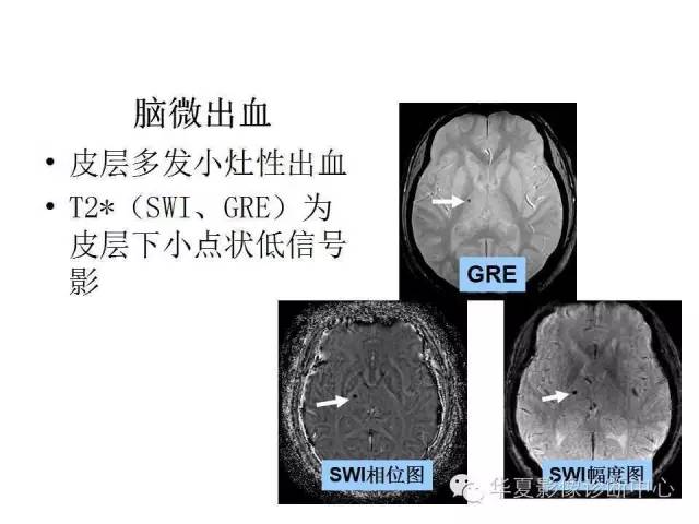 【PPT】脑小血管病