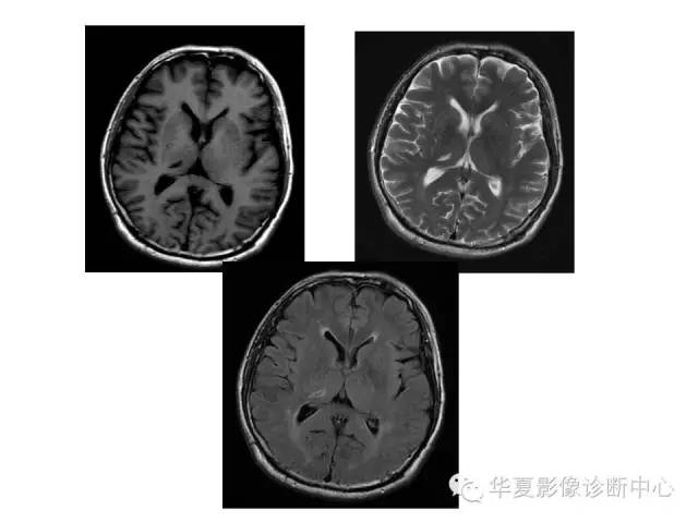 【PPT】脑小血管病