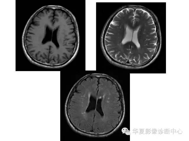 【PPT】脑小血管病