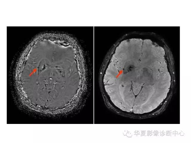 【PPT】脑小血管病