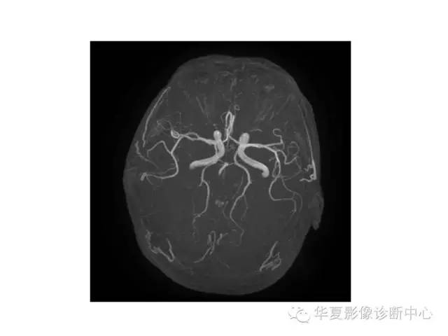 【PPT】脑小血管病