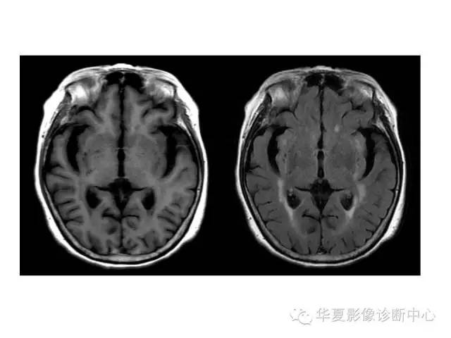 【PPT】脑小血管病