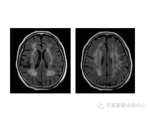 【PPT】脑小血管病