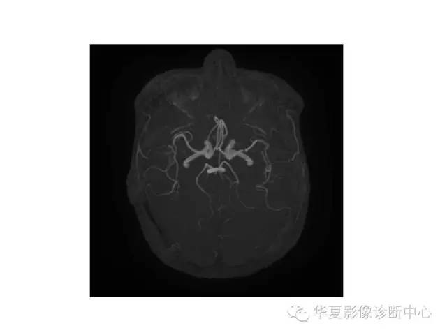 【PPT】脑小血管病