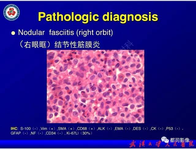 【PPT】眼眶结节性筋膜炎影像诊断