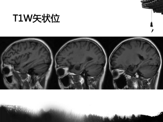 【病例】毛细胞型星形细胞瘤1例MR影像表现与鉴别