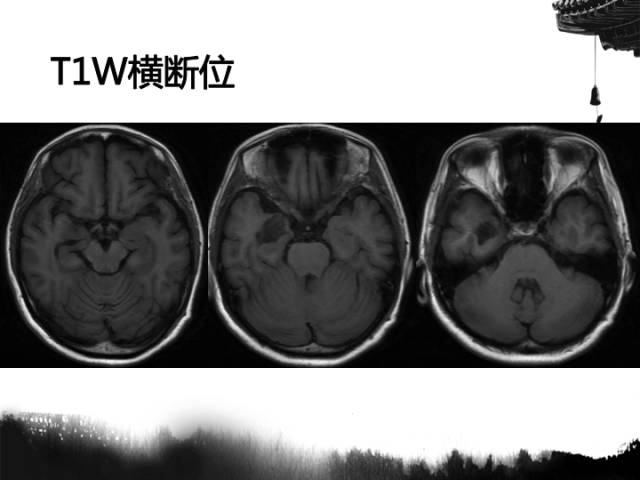 【病例】毛细胞型星形细胞瘤1例MR影像表现与鉴别
