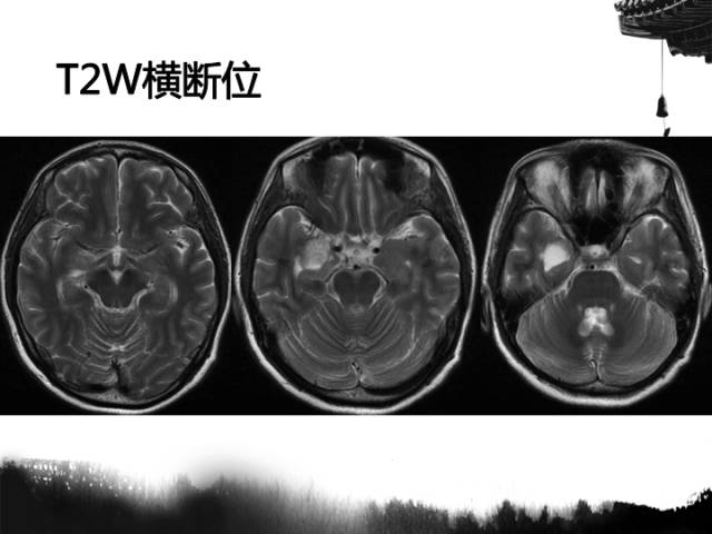 【病例】毛细胞型星形细胞瘤1例MR影像表现与鉴别