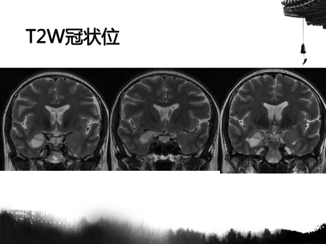 【病例】毛细胞型星形细胞瘤1例MR影像表现与鉴别