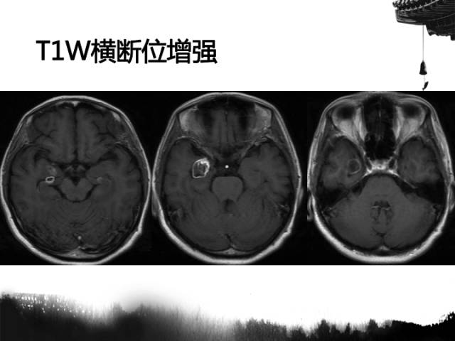 【病例】毛细胞型星形细胞瘤1例MR影像表现与鉴别