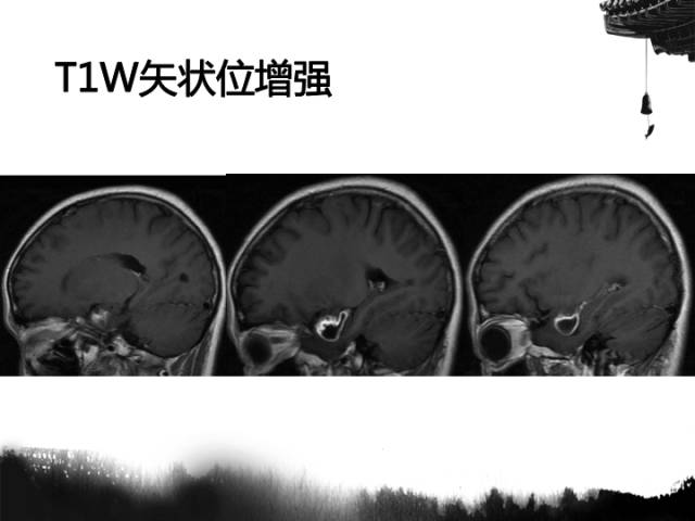 【病例】毛细胞型星形细胞瘤1例MR影像表现与鉴别