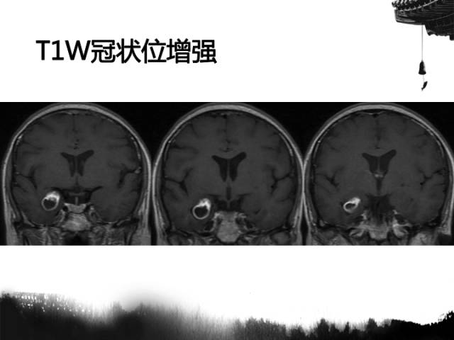 【病例】毛细胞型星形细胞瘤1例MR影像表现与鉴别