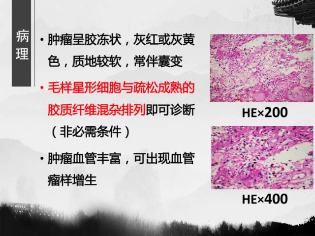 【病例】毛细胞型星形细胞瘤1例MR影像表现与鉴别