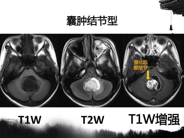 【病例】毛细胞型星形细胞瘤1例MR影像表现与鉴别