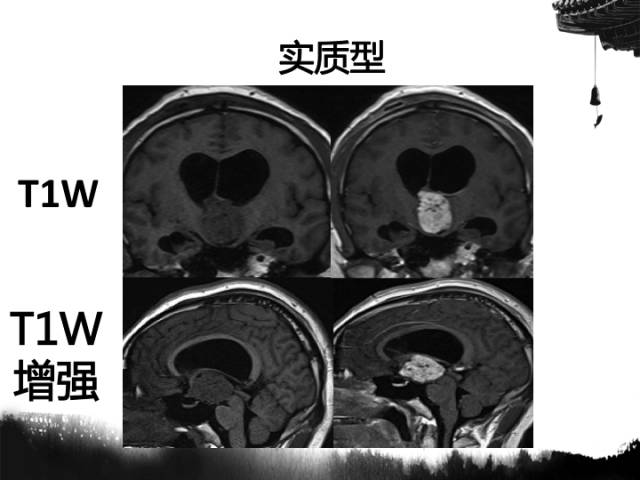 【病例】毛细胞型星形细胞瘤1例MR影像表现与鉴别