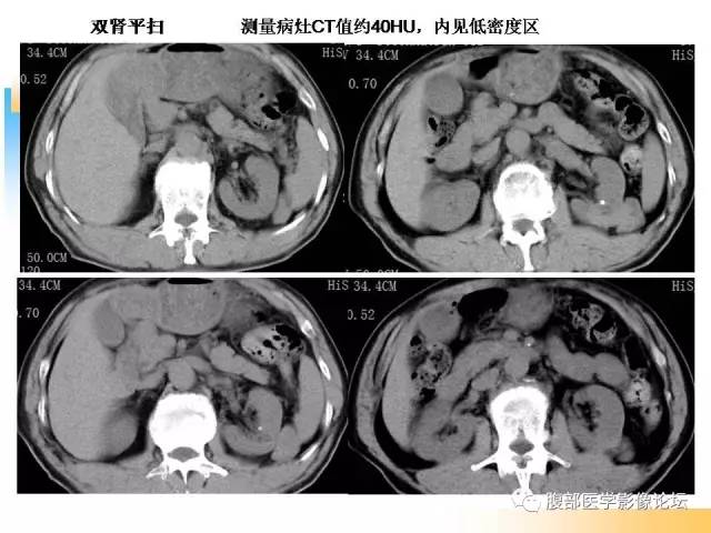 【病例】左肾上皮样血管平滑肌脂肪瘤1例CT