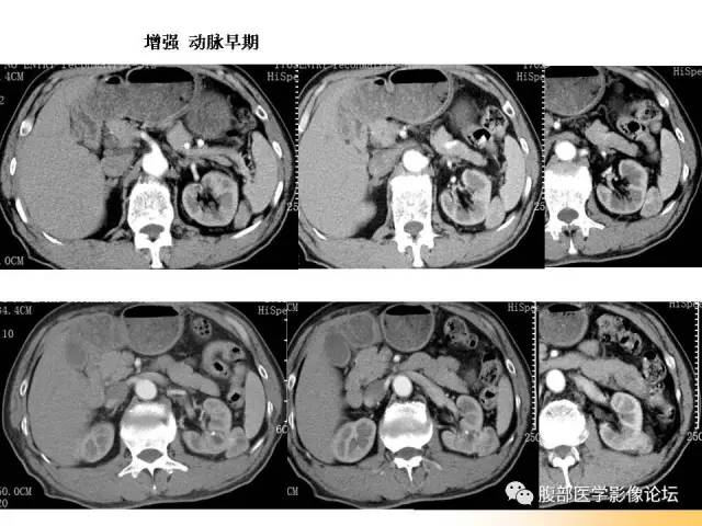 【病例】左肾上皮样血管平滑肌脂肪瘤1例CT
