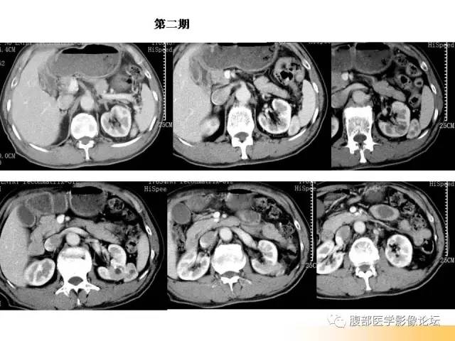【病例】左肾上皮样血管平滑肌脂肪瘤1例CT