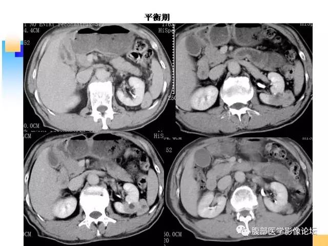 【病例】左肾上皮样血管平滑肌脂肪瘤1例CT